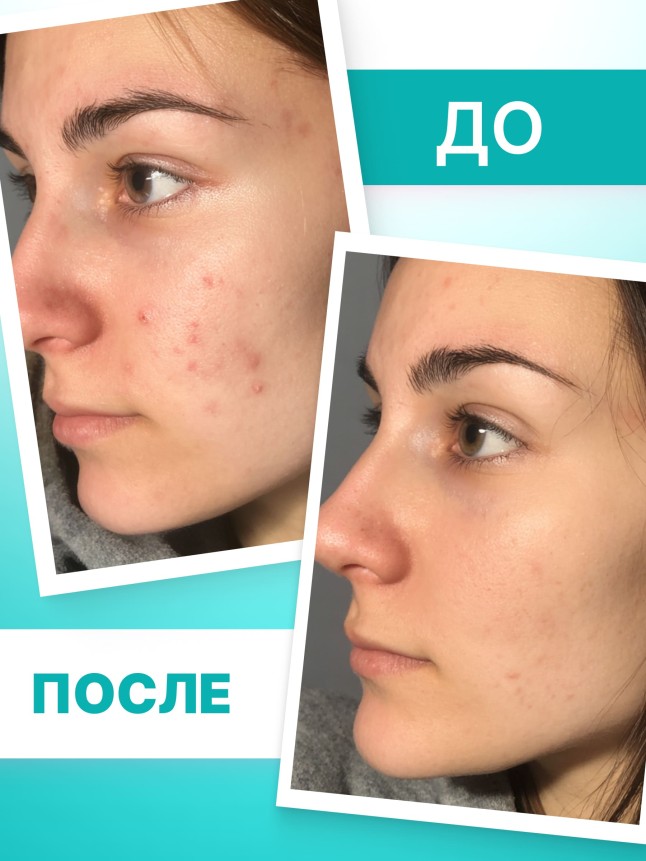 Заказать Крем локального действия для проблемной кожи TeenSkin