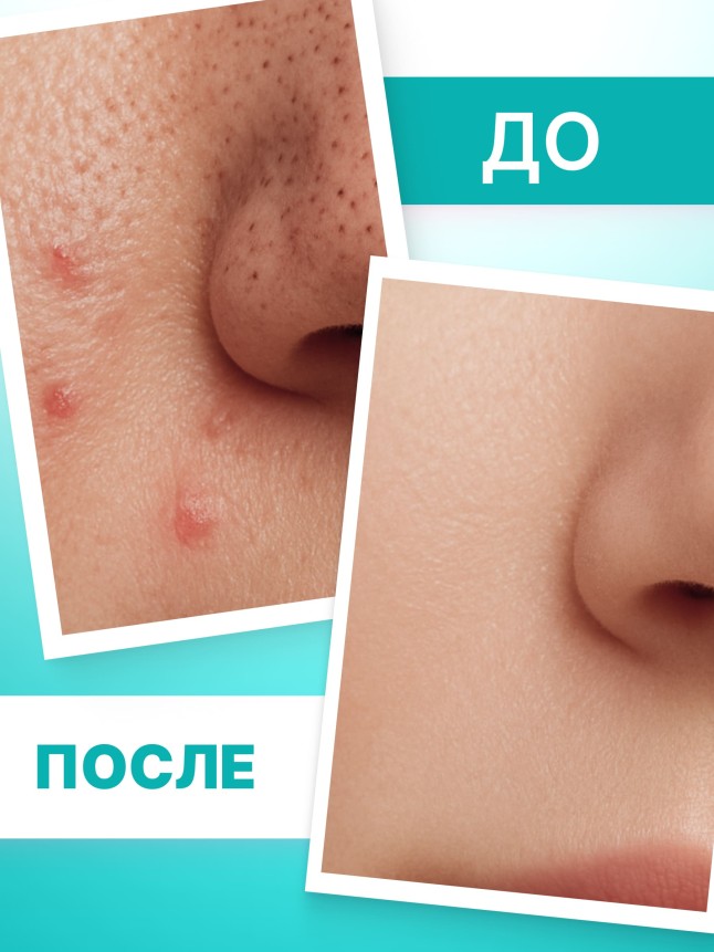 Заказать Лосьон от черных точек TeenSkin