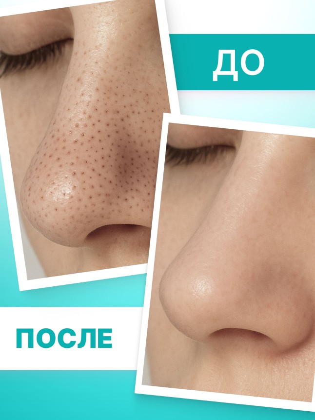 Заказать Очищающие полоски для носа TeenSkin